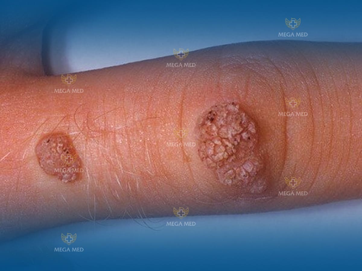 Sùi mào gà ở nữ giới